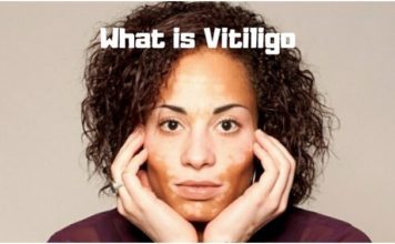 What is Vitiligo- What causes Vitiligo