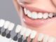 Why Do You Need to Consider Dental Implants for Missing Teeth