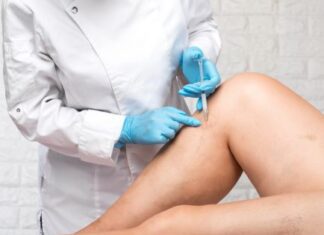 finding relief a guide to varicose vein treatment